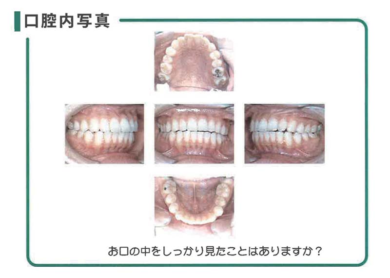 口腔内写真