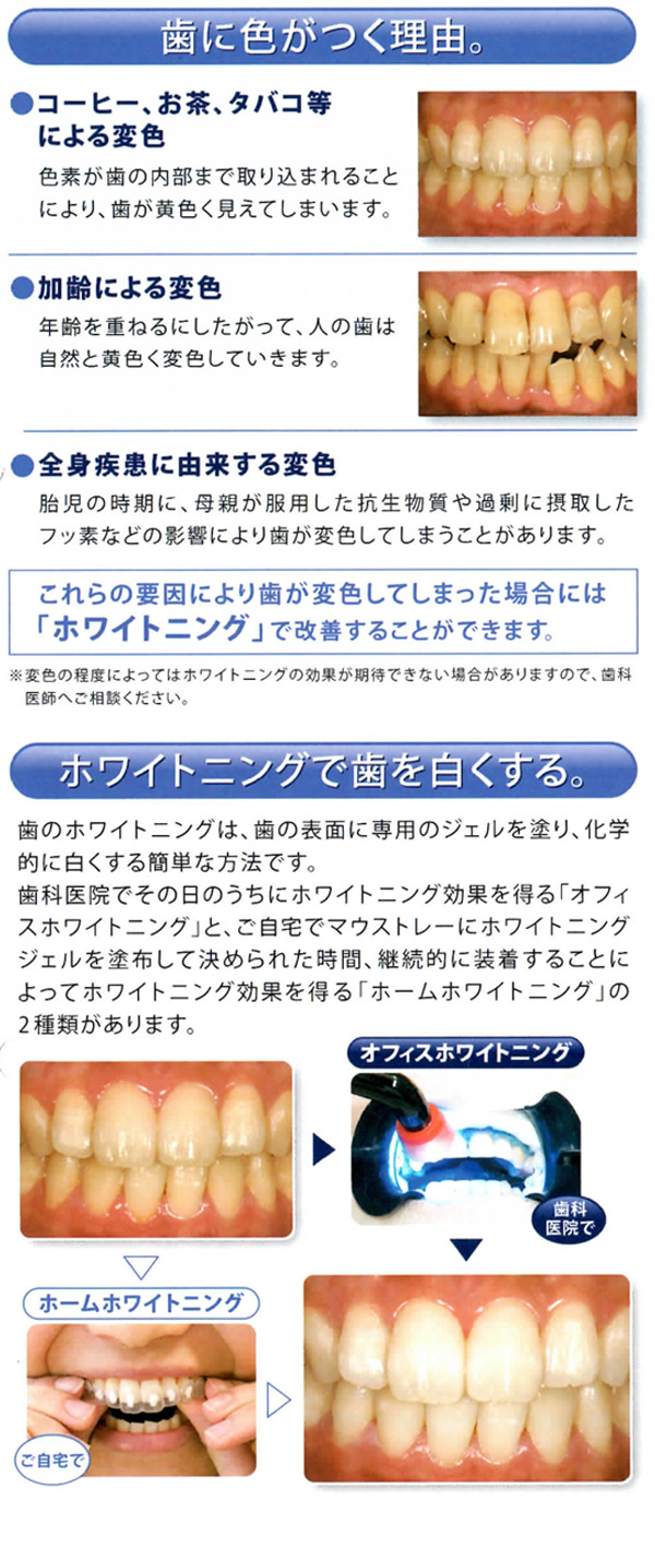 ホワイトニング
